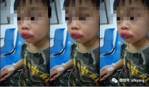 男孩吃葡萄過敏腫成嘟嘟嘴怎么回事？畫面詳情曝光網友忍不住笑了(圖1)