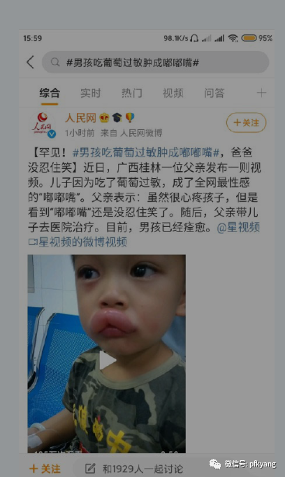 男孩吃葡萄過敏腫成嘟嘟嘴怎么回事？畫面詳情曝光網友忍不住笑了(圖3)